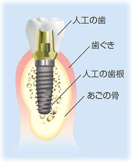 インプラント