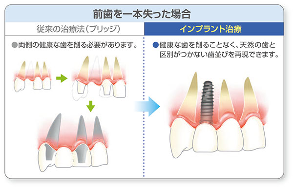 前歯を一本失った場合