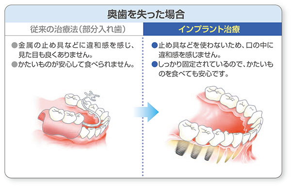 奥歯を失った場合