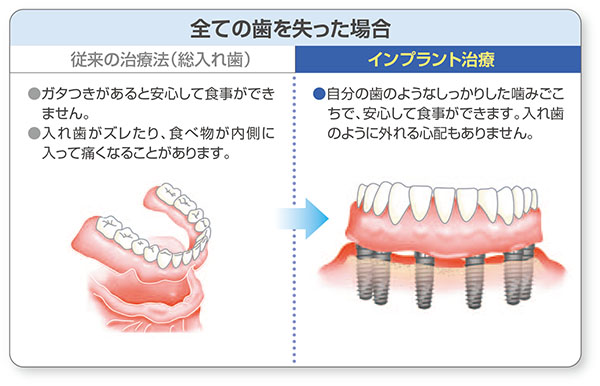 全ての歯を失った場合