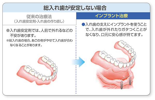 総入れ歯が安定しない場合